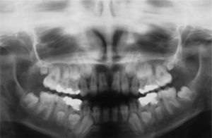 Panoramic radiograph of a 2-year-old patient at diagnosis who was submitted to chemotherapy and 1,800 cGy irradiation. Note microdontia of the lower left premolars and second permanent molar.