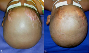 Hypertrophic scar regression in a burned child after four years (A and B). Hypertrophic scars are usually raised, although rarely elevated more than 4 mm above the skin; red or pink in color; hard; and pruritic. Additionally, these scars do not extend beyond the general geographic margins of the wound and tend to regress over time.