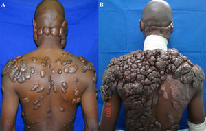 Keloid evolution after seven years (A and B). Keloids continue to evolve over time, without a quiescent or regressive phase, and infiltrate the surrounding tissue.