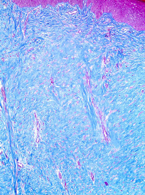 The histology of hypertrophic scars is characterized by replacement of the papillary and reticular dermis by scar tissue with prominent vertically oriented blood vessels. The fibrous bundles are parallel and horizontal in the upper dermis. (Masson