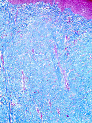 The histology of hypertrophic scars is characterized by replacement of the papillary and reticular dermis by scar tissue with prominent vertically oriented blood vessels. The fibrous bundles are parallel and horizontal in the upper dermis. (Masson's trichrome, 100X).