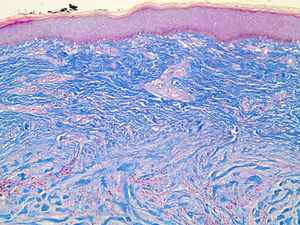 The histology of keloids is characterized by well-demarcated and disorganized fibrous tissue usually involving the upper half or two-thirds of the dermis. The collagen fibers are noticeably thicker (Masson's trichrome, 100X).