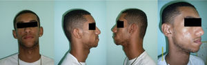 patient with facial lipoatrophy associated with HIV.