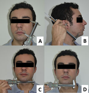 Anthropometric measures: A = medial portion of the face; B = lateral portion of the face; C = masseter; D = buccinators.