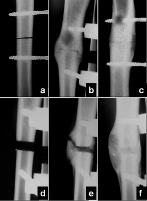 Radiographic controls for both the linear (above) and resection (below) osteotomies, showing the callus evolution with postoperative time (a and d: immediately afterwards; b and e: 60 days; c and f: 90 days).