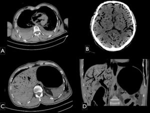 PMCT images, multiplanar reconstruction axial (A and B) and coronal (C) pulmonary window. Findings in parenchymal organs: A) fluid-fluid level with higher protein decanted in the bilateral pleural space, with a larger volume on the right side; B) gas distributed in intracranial arterial and venous compartments; C) and D) intrahepatic gas in the systemic and portal venous drainage systems (arrows).