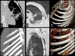 PMCT images, multiplanar reconstruction coronal (A), coronal minimum intensity projection (B) and axial (C) pulmonary window; three-dimensional reconstruction technique for maximum intensity projection (D) and volume rendering showing bony structures in the left oblique lateral view. Note the lesion wound in the skin and the lung injury (A and B), the details of the lesion in the fifth left rib (in C, D and F) and the distance between the lateral aspect of the path of lung injuries and skin lesions and rib while the arm is positioned down (detail B).
