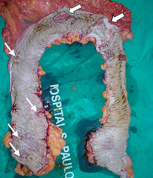 Macroscopic evaluation of the total colectomy product from the same patient as shown in Figure1, a surgical specimen with synchronous tumors (large arrows) and several scattered polyps (thin arrows).