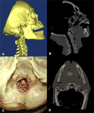 A diagram showing the creation of simulative atlantoaxial dislocation. A Lateral view of the cadaver (CT reconstruction) after the creation of simulative dislocation; B Lateral-viewed CT scan; C Top view from the transcranial approach; D Axial-viewed CT scan.