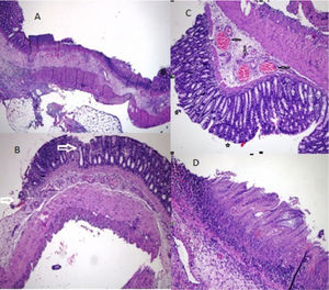 Group histopathology. A. Common massive areas of epithelial detachment and presence of transmural necrosis. [“Chiu” classification grade 5] (H&E x40). B. Massive areas of epithelial detachment (shown with an arrow) [“Chiu” classification grade 3] (H&E x100). C. Subepithelial “Gruenhagen's space” (shown with an asterisk) and capillary congestion (shown with an arrow) [“Chiu” classification grade 1] (H&E x200). D. Area of mucosal ischemic necrosis (H&E x200).