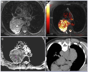 A 62-year-old woman who presented with a heterogeneous mass in the right posterior mediastinum. The entire mass showed heterogeneous signal hyperintensity on T2-weighted magnetic resonance images (a) and fused T1- and diffusion-weighted images. (b) Note the remarkable signal hyperintensity in the posterior periphery of the lesion (arrow) compared with other areas, with definitive signs of restriction on the apparent diffusion coefficient (ADC) map. (c) The ADC value in the target area was 0.89×10-3 mm2/s. The needle was directed to this area during computed tomography–guided biopsy. (d) Histopathological analysis yielded a diagnosis of pleomorphic leiomyosarcoma.