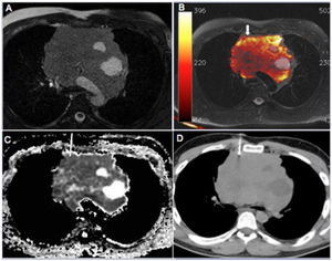 A 35-year-old man with a large mass in the anterior mediastinum. The mass showed heterogeneous signal intensity on T2-weighted images (a) and fused T1- and diffusion-weighted images. (b) Note the circumscribed areas of signal hyperintensity suggestive of cysts but also the remarkable signal hyperintensity (arrow) away from the cystic areas near the right anterior lesion margin, with definitive signs of restriction on the apparent diffusion coefficient (ADC) map. (c) The ADC value in the target area was 0.61×10-3 mm2/s. This mass was subjected to computed tomography–guided biopsy (d), and histopathological examination yielded a diagnosis of gray zone lymphoma.