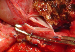 View of the end-to-side anastomosis between the hepatic vein of the graft and the inferior vena cava. The inferior vena cava is partially clamped.