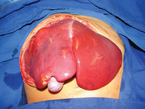 Surgical aspect of a patient with multifocal hepatoblastoma. Note the multiple nodes affecting all of the liver parenchyma (PRETEX IV). The patient underwent total hepatectomy and living donor liver transplantation.