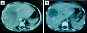 CT scan of a patient with hepatoblastoma in the right hepatic lobe before (a) and after (b) chemotherapy. The tumor size decreased, and the patient underwent right hepatectomy with surgical margins that were free of tumor cells.