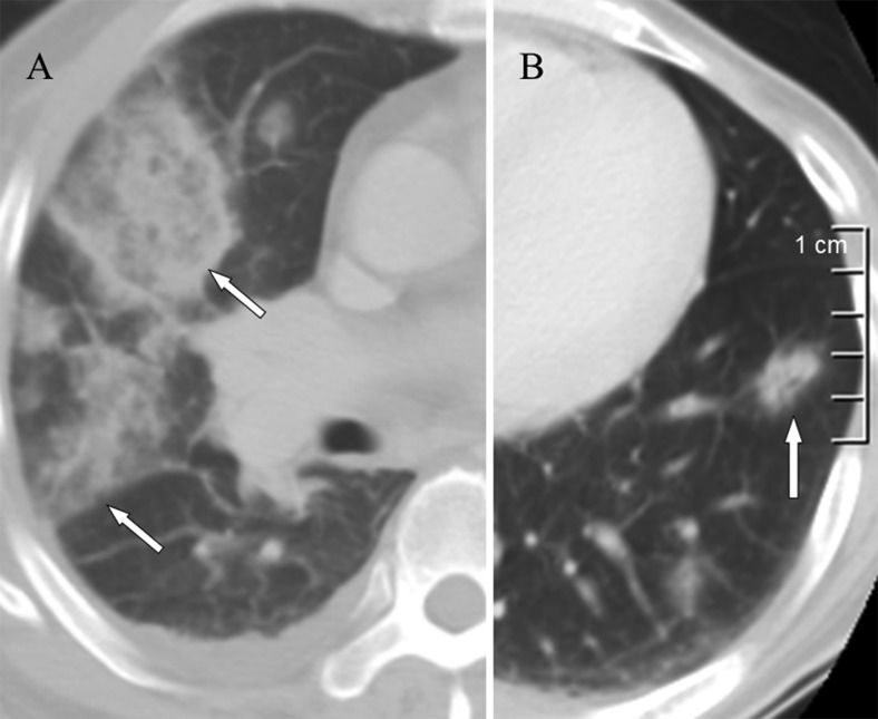 Septic Abscess Septic pulmonary embolism caused by a Klebsiella pneumoniae liver ...