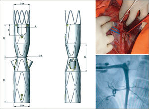 Hourglass endograft adapted for placement in the porcine model of juxtarenal aneurysm (left) and images of an aortography in one pig (right).
