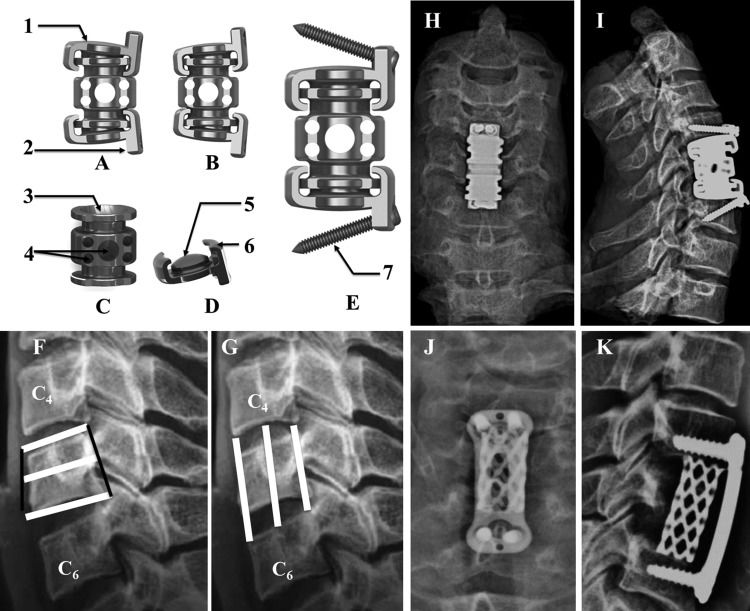 Intervertebral Device Artificial disc and vertebra system: a novel motion preservation device ...
