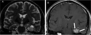A MRI of a ganglioglioma in a 45-year-old man with refractory left partial mesial temporal lobe epilepsy. A) A coronal T2-weighted image and B) a contrast-enhanced coronal T1-weighted image showing a solid-cystic lesion in the mesial left temporal lobe with intense enhancement of the soft tissue component (white arrows).