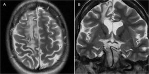 Rasmussen encephalitis confirmed via biopsy in a 37-year-old woman with refractory partial motor epilepsy. A) An axial T2-weighted image and B) a coronal T2-weighted image showing atrophy and gliosis of the right frontal lobe.