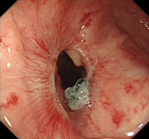 One patient experienced anastomosis stricture after 3 months post-operation as determined by an electronic colonoscopy.