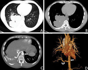 A 32-year-old male with intralobar sequestration. A and B: Axial multidetector computed tomography images show a mass in the right lower lobe (S); C: An axial multidetector computed tomography image obtained at a level lower than A and B shows an aberrant artery (curved arrow) arising from the thoracic aorta (straight arrow) to the sequestered lung (S); D: A 3D multidetector computed tomography volume rendering image shows an aberrant artery (curved arrow) from the thoracic aorta (straight arrow) to the right lower lobe.