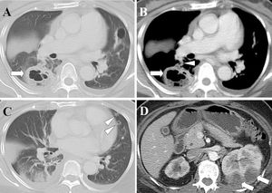 Renal abscesses with septic pulmonary emboli. (A) A lung window of a cross-sectional CT scan shows a lung abscess with a diameter of 4.5 cm in the right lower lobe (arrow). (B) A contrast-enhanced CT scan (mediastinum window) in the same image plane shows a lung abscess (arrow) with a feeding vessel sign (arrowhead). (C) A lung window of a cross-sectional CT scan shows two nodules with cavities in the left upper lobe (arrowheads). (D) An abdominal CT scan shows left renal abscesses (arrows). The patient was a 52-year-old woman whose blood cultures were positive for Escherichia coli.