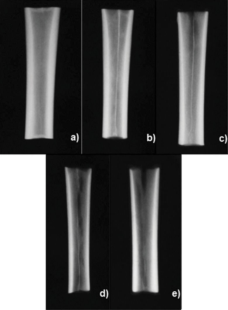 Rarefaction Radiograph Correlation between ultrasound velocity and densitometry in fresh and ...
