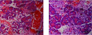 Diazoxide decreases necrosis of acinar cells in acute pancreatitis (AP). AP induction caused necrosis of multiple pancreatic acinar cells (left image). In the group that received diazoxide, there was a significant reduction in the number of necrotic cells (right image) (n=20 in each group, p=0.015, Mann–Whitney test).