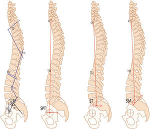Angle measurements in full-length spine radiographs. Pelvic incidence (PI). Sacral slope (SS). Pelvic tilt (PT). Lumbar lordosis (LL). Thoracic kyphosis (TK). Spinosacral angle (SSA). Spinal tilt (ST). Spinopelvic tilt (SPT).