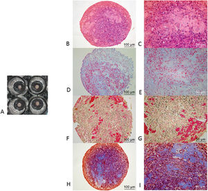 Histological analysis: A) Macroscopic aspect of micromasses after 21 days in TGF-β3-stimulated culture; B and C) The production of cartilage matrix is shown in pinkish and bluish staining (high amount of proteoglycans), and cell nuclei are shown in blue by HE; D and E) GAGs are shown in light blue by AB, and collagen production is shown in blue staining that permeated all the sections in red by MT; the cells contained black nuclei; F and G) In PR-stained sections, collagen appears pale yellow but becomes red when collagen fibers aggregate; H and I) In MT-stained sections, collagen production appears in blue staining that permeated all the sections in red; the cells contained black nuclei.