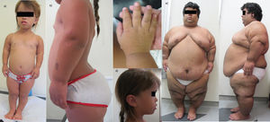 Clinical findings in two achondroplastic patients. a-c) The clinical findings in a 6-year-old female patient. a) Anterior view of the patient shows rhizomelic short-limb dwarfism and macrocephaly; b) the profile view demonstrates the common prominent kyphosis and lumbar lordosis; c) the typical hand in this patient shows brachydactyly with a trident configuration; d) the profile picture demonstrates the common phenotypic changes in achondroplasia: frontal bossing, midface hypoplasia and low nasal bridge; e) a 20-year-old male patient whose weight is 148 kg and whose height is 139.5 cm.