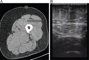 RFCSA evaluation by CT (A) and US (B). RFCSA: Cross-sectional area of the rectus femoris; CT: Computed tomography; US: Ultrasound. Continuous green line: Rectus Femoris diameter as measured by CT; dotted yellow line: RFCSA as evaluated by US