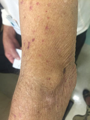 Patient with pellagra, in whom we observed dry skin and scratches from intense itching.