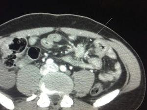 CT showing a characteristic image of mesenteric fibrosis.