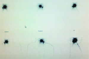 Dynamic scan sequence of 120-second frames for 30 min following the injection of 99Tec. Right tonsillar tumor with a sentinel lymph node at level II on the right side.