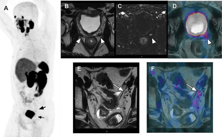 Pmsa Radiology Clinical perspectives of PSMA PET/MRI for prostate cancer | Clinics