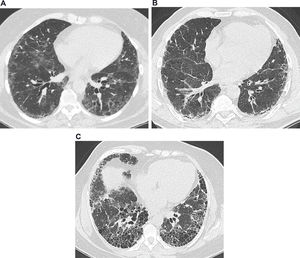 Common features on high-resolution computed tomography in interstitial lung diseases. (a) Images from a 63-year-old female presenting a nonspecific interstitial pneumonia pattern. There are predominant areas of ground-glass opacities, with some traction bronchiectasis and cortical interlobular septal thickening. (b) Images from a 61-year-old male with idiopathic pulmonary fibrosis. There are diffuse areas of interlobular septal thickening, predominantly in the cortical lung zones. (c) Images from a 56-year-old female with idiopathic pulmonary fibrosis. There are extensive areas of honeycombing, with some interlobular septal thickening.