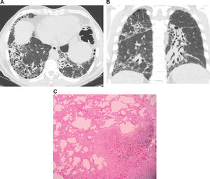 Images from a 53-year-old male with idiopathic pulmonary fibrosis. (a) Axial and (b) coronal computed tomography images demonstrating areas of honeycombing, reticulation and subpleural predominance. (c) Histopathology images demonstrating areas of marked fibrosis, with architectural distortion and fibroblast foci, alternating with areas of normal parenchyma.