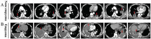The chest CT image characteristics of pulmonary abscesses in patients without or with empyema A, Representative images from 76 cases of pulmonary abscess without empyema. B, Representative images from 25 cases of pulmonary abscess-related empyema. The arrow indicates a pulmonary abscess.