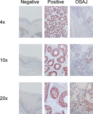 Immunohistochemical staining with MAGE-A Mab 6C1 (Dako). Left column: mucosal sections were used as negative controls; middle column: testis tissue sections were used as positive controls; right column: representative sections of OSAJ tissues; each at 4x, 10x and 20x magnification.