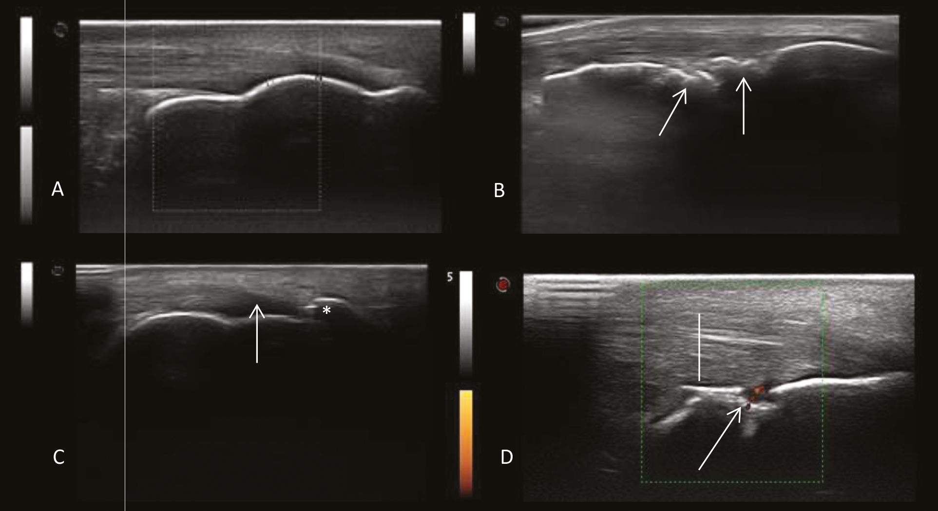 Enthesis On Radiograph Ultrasound of entheses in ankylosing spondylitis patients: The ...