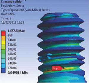Maximum stress found at R1 (abutment-retaining screw), 2 s, for the M1 model.
