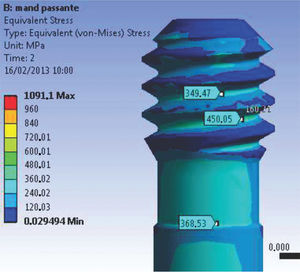 Abutment-retaining grooves (M2), presenting stress concentration values lower than σy. Abutment-retaining grooves (M2), presenting stress concentration values lower than σy.