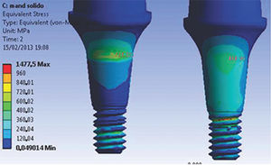 Abutment neck (R2) stress values for the M1 model. Left side – in the direction of the applied force; right side – opposite of the direction of the applied force. Abutment neck (R2) stress values for the M1 model. Left side – in the direction of the applied force; right side – opposite of the direction of the applied force.