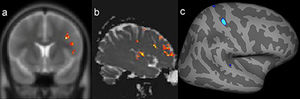 Example of a patient with a presumed epileptogenic zone in the left frontotemporal region (patient 7) that was concordant with three quantitative measures. The results of postprocessing of T2 relaxometry maps by Statistic Parametric Mapping (SPM12) software (a: coronal plane) and mean diffusion maps (b: sagittal plane), as well as cortical thickness by FreeSurfer (c: quadrature decoder [QDEC]), showing abnormalities notably in the left frontal lobe.