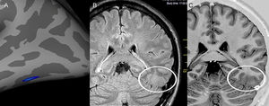 Images from patient 24 who was initially classified as magnetic resonance imaging (MRI) negative. After visual evaluation guided by postprocessing, a potentially epileptogenic structural lesion was identified in the same region considered the epileptogenic zone by electroclinical data. A) Results of the postprocessing of cortical thickness in the FreeSurfer software environment, showing cortical thickening in the left inferior temporooccipital transition. Nonvolumetric coronal fluid attenuation inversion recovery (FLAIR) (B) and T2 short tau inversion recovery (STIR) with inverted window (C) acquisitions showing discrete focal cortical thickening and white–gray transition blurring (white circles) in the same region identified by the quantitative analysis.