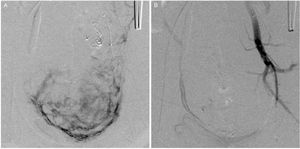 (A) Angiographic images obtained before embolization depicting the enhancement of the uterine vessels. (B) Final angiographic results after embolization. Note the absence of enhancement in the uterine territory and the flow arrest at the left internal iliac artery branches.