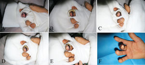 The flap appearance after transplantation on Day 1 (A), Day 3 (B), Day 5 (C), Day 7 (D), Day 9 (E), and Day 11 (F). The blood supply as good without obvious congestion.