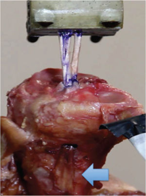 Photo of an anatomical piece of the tibia from group A (fixation without the screw), showing the mechanical trial with the Kratos apparatus in which the tibia was maintained on an immobile support. Arrow: Preservation of the tibial insertion of the hamstring tendons.